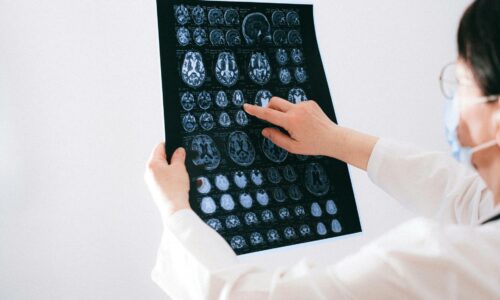 Medzi Alzheimerovou chorobou a rakovinou je zaujímavé prepojenie. Nový výskum ukazuje, čo je za tým